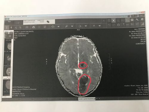 The scans which confirmed little Quinn had suffered a stroke in March.