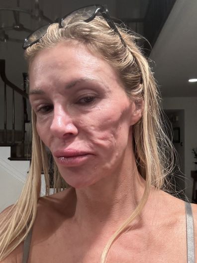 Brandi Glanville menghadapi cacat