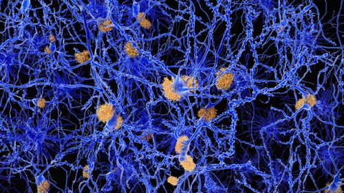 A new drug to treat Alzheimer’s has shown “very encouraging” results in global trials.