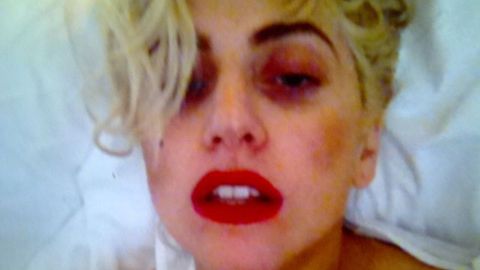 Gaga's black eye