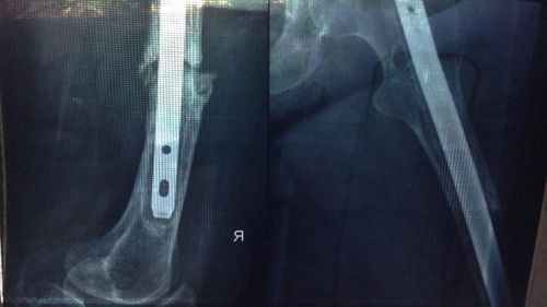 X-rays of Christine's right leg bone before her many surgeries.