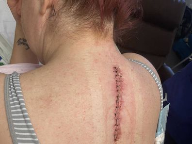 Allison Willcox shows just one of the scars on her back from surgery.