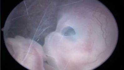 10 week old fetus.