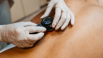 skin cancer melanoma check