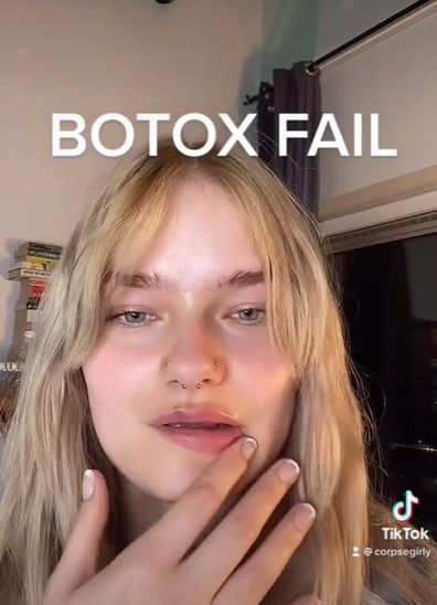 Botox fail in chin