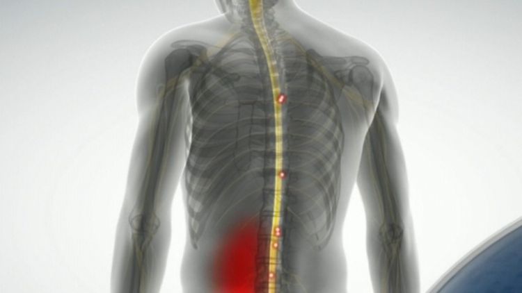 Spinal cord stimulation doesn t help with back pain says new review - The  University of Sydney