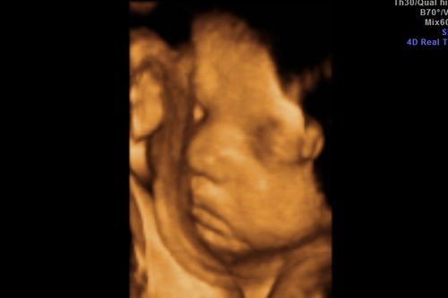Pregnancy scan Melissa