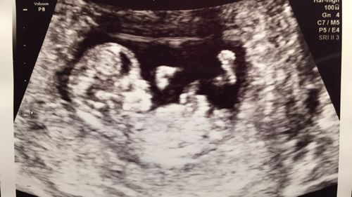 An ultrasound of the couple's baby, which is due on February 2. 