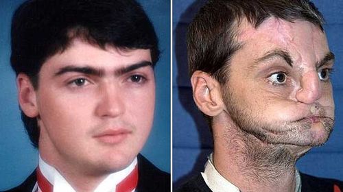 Richard Norris before and after his accident. (Source: AAP/University of Maryland Medical Centre)