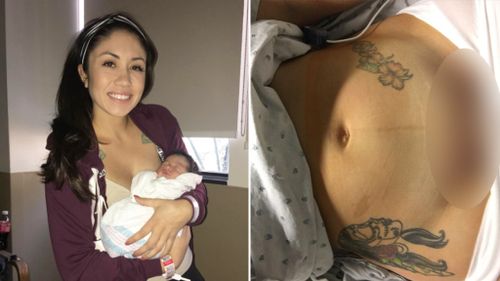 Mum posts photo of C-section scar to reassure expectant mothers