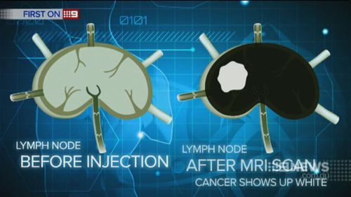 The method lights up cancerous lymph nodes, while the safe ones appear black. (9NEWS)