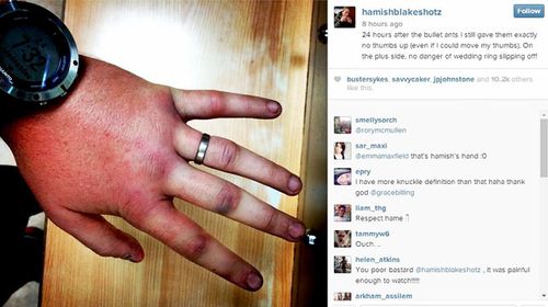 Hamish Blake's injured hand still without feeling 24 hours after an Amazonian bullet ant ritual. (Instagram)