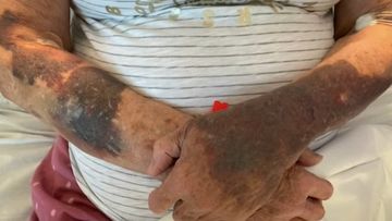 Elderly woman develops severe bruising days after vaccine
