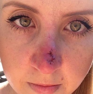 Lauren from Married At First Sight shares skin cancer photo