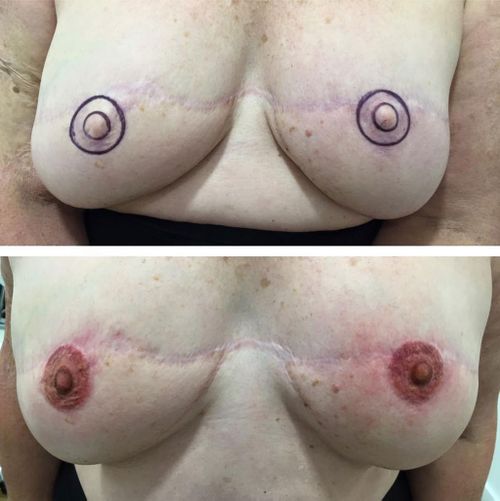 Breast cancer survivors' nipple tattoos. (Facebook)