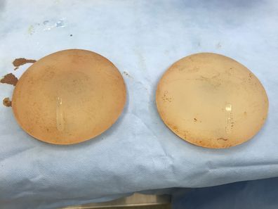 Robyn Smith's implants after being removed.