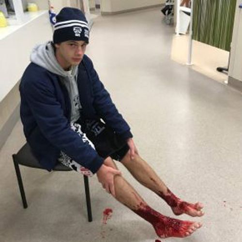 It's not yet clear what attacked the 16-year-old's feet. (Fairfax)