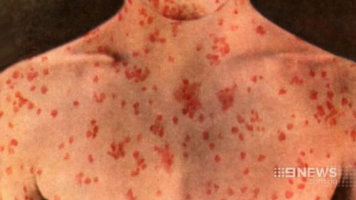 Measles has an incubation period of up to 18 day. (9NEWS)