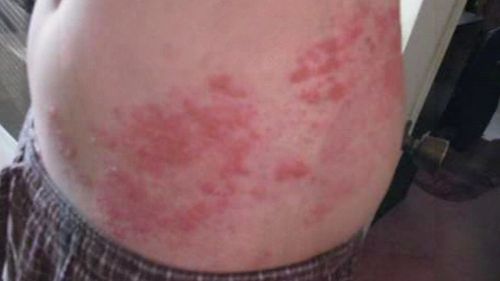 Up to one-third of Australians are prone to developing shingles.