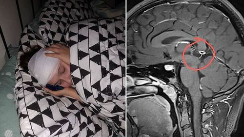 Amelia had a rare 10mm by 11mm pineal tumour at the centre of her brain.