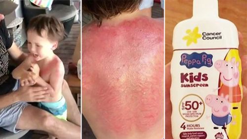 Rivers Jasper, three, was left with severe burns after his parents applied Peppa Pig branded sunscreen. (Facebook/Shannae Jasper)