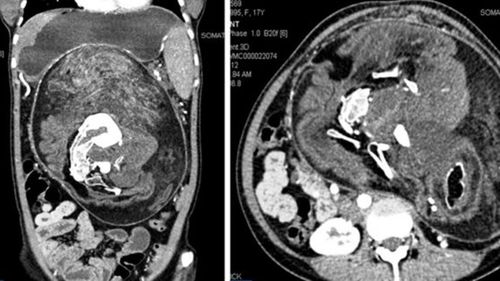 A CT scan showing a mass in the teen's stomach. Image: Anil Kumar, et al./BMJ Case Reports