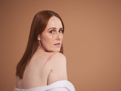 Skin cancer survivor Courtney Mangan for the Skin Check Champions campaign.