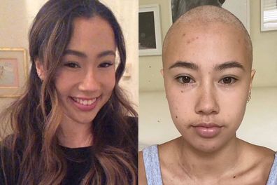 Maddie King before and after losing her hair to cancer treatment.