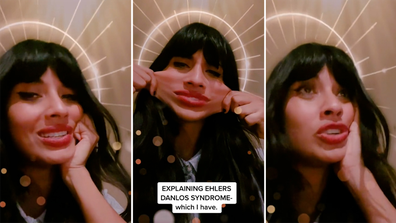 Jameela Jamil reveals the impact of Ehlers-Danlos syndrome.