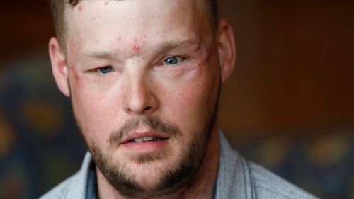 Face transplant recipient Andy Sandness speaks during an interview. (AAP)