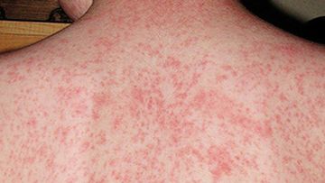 measles alert issued in Brisbane after contagious child visits several locations.