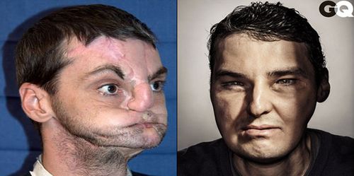 Richard Norris has made the cover of GQ after receiving a face transplant.