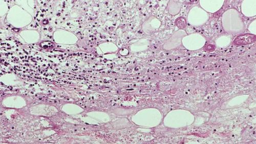 Mycobacterium ulcerans which cause the Buruli ulcer. (Pathology of Infectious Diseases)