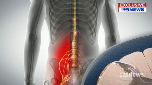 New Stimulator Delivers Back Pain Relief — Pain News Network