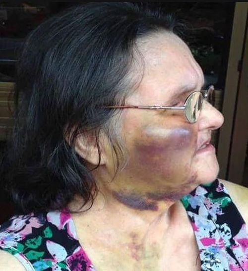 Elizabeth Hannaford was assaulted in an Adelaide nursing home after repeatedly pulling cords out of her bed. 