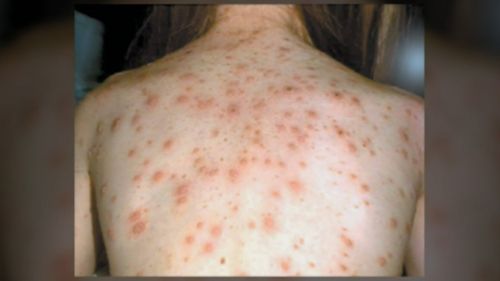 Three to four days after fever symptoms, a rash spreads across the body.