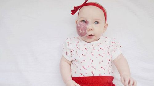 Fed up US mother speaks out after constant comments on her baby’s birthmark