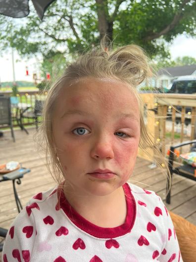 Mum warns against deadly 'poison hemlock' plant after daughter's horrible reaction.
