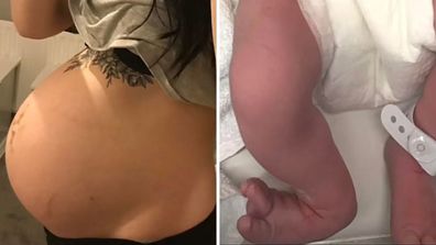 Bethany Love shares photo of baby's misshapen feet that were stuck under her rib cage