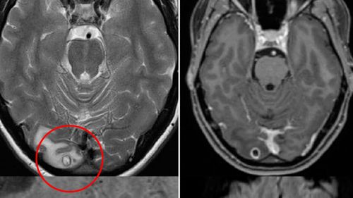 Doctors mystified by clump of tapeworm larvae in Melbourne woman's brain