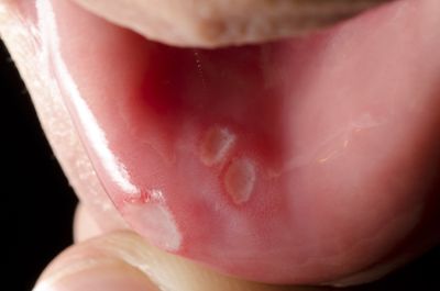 <strong>Mouth ulcers</strong>