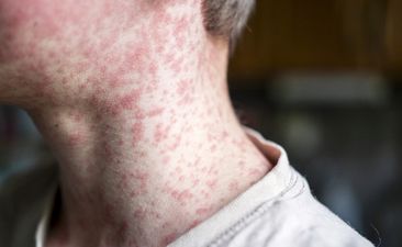 Measles viral disease, human skin covered with measles rash, vaccination concept