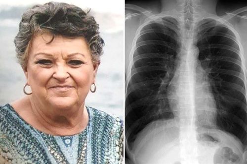 Linda Goldsmith (left) was living with COPD for years before she was diagnosed. An X-ray showing a patient with COPD (right).