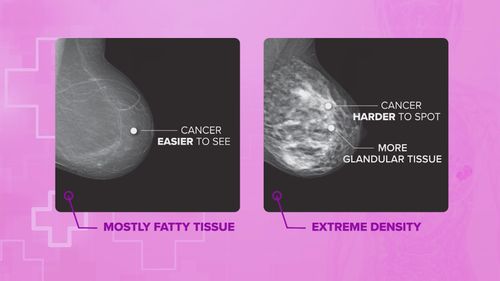 Women in South Australia who receive a free mammogram will be notified whether they have dense breasts - one of only two states to do so.