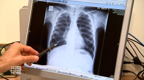 Australians living with the debilitating disease cystic fibrosis will soon have access to a new treatment on the Pharmaceutical Benefits Scheme (PBS).