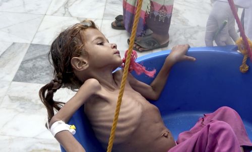 Severely malnourished seven-year-old Amal Hussein, whose name means "hope" in Arabic, is weighed at Yemen’s Aslam Health Centre in Hajjah in August.
