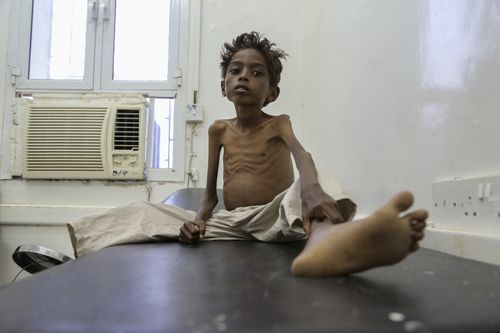 Save the Children estimates 85,000 children have died from hunger in the three years of war in Yemen.