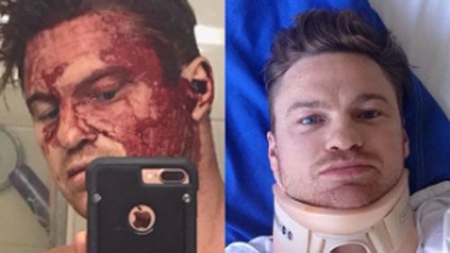 Sylvia shared these photos after his balcony fall. 
