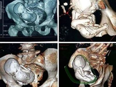 3D CT Scan of a lithopedion, a calcified fetus