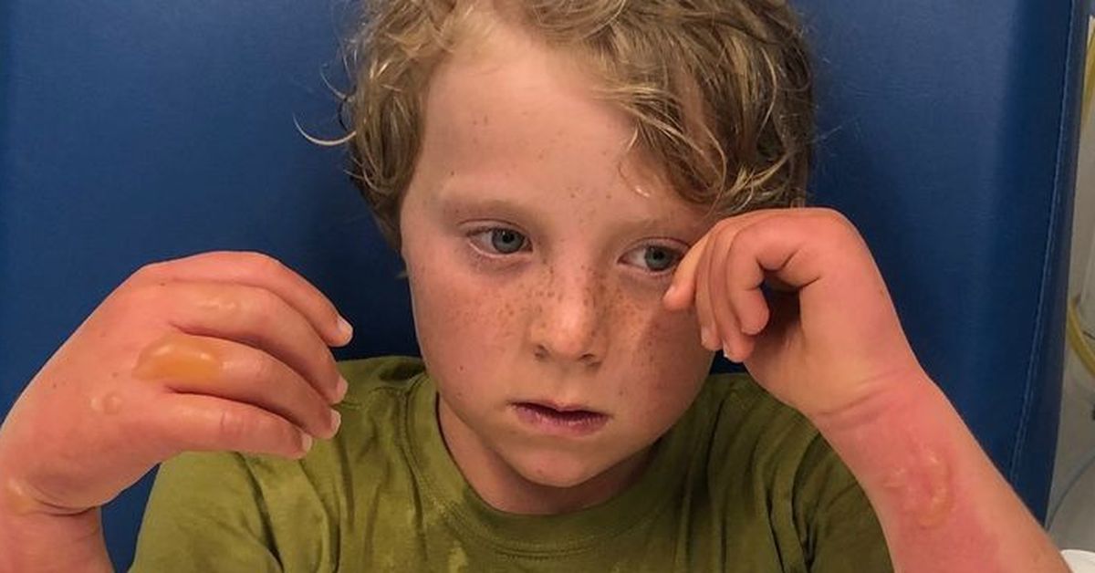 Margarita burns Mum's warning after son suffers horror burns from